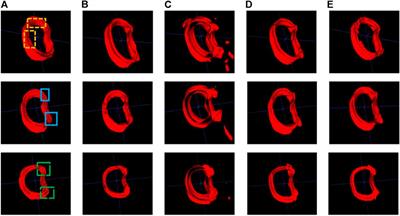 Automated segmentation of vertebral cortex with 3D U-Net-based deep convolutional neural network